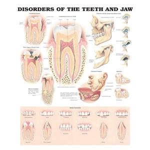 Poster Disorders of the Teeth and Jaw 20 in x 26 in With Lamination Ea