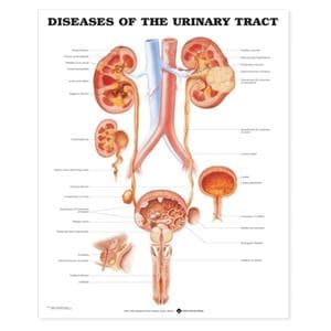 Diseases of Urine Tract Educational Chart 20x26" Each