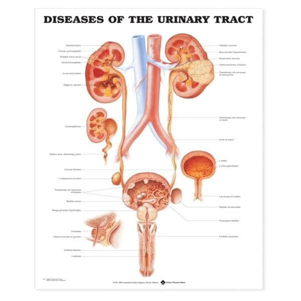Diseases of Urine Tract Educational Chart 20x26" Each