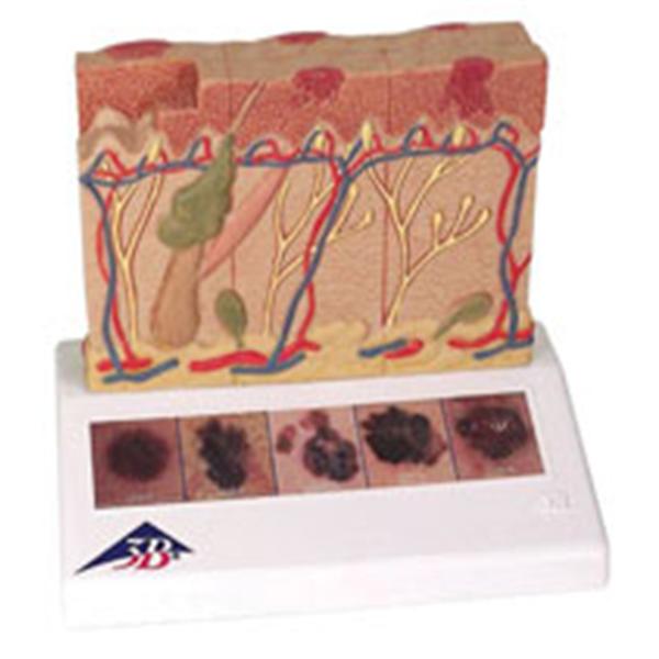 Skin Cancer Anatomical Model Each
