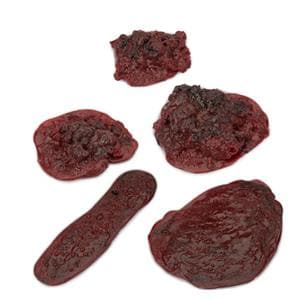 Life/form Clots/Hemorrhages Model Set Ea