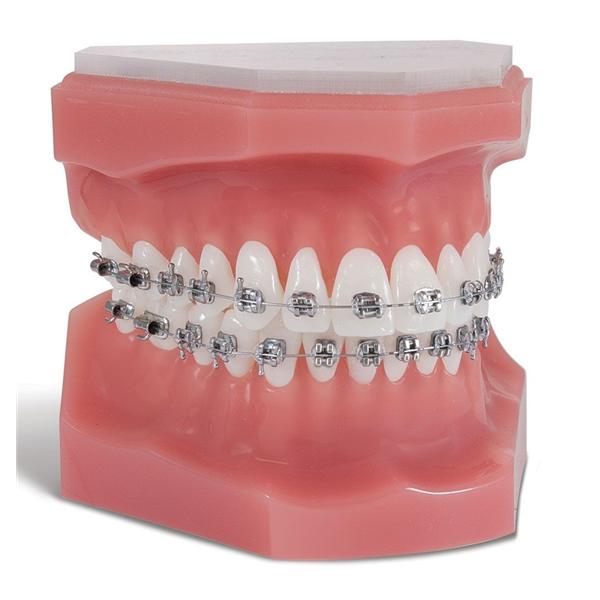 Pinnacle Bracket .018 in Upper Right 10/Pk