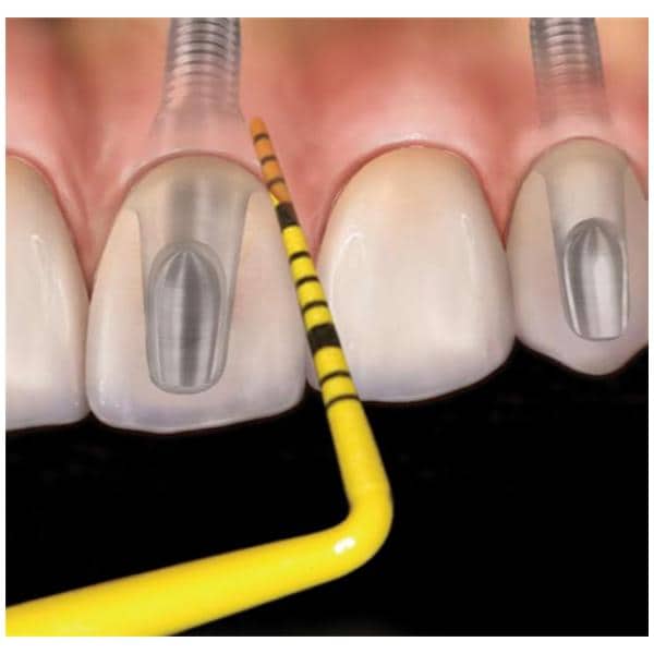 Colorvue Periodontal Probe Promo Kit Size UNC12 Single End #6 Yellow Kit