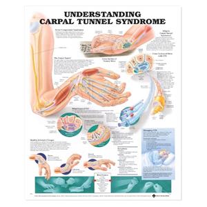 Understanding Carpal Tunnel Syndrome Educational Chart 20x26" Fle...