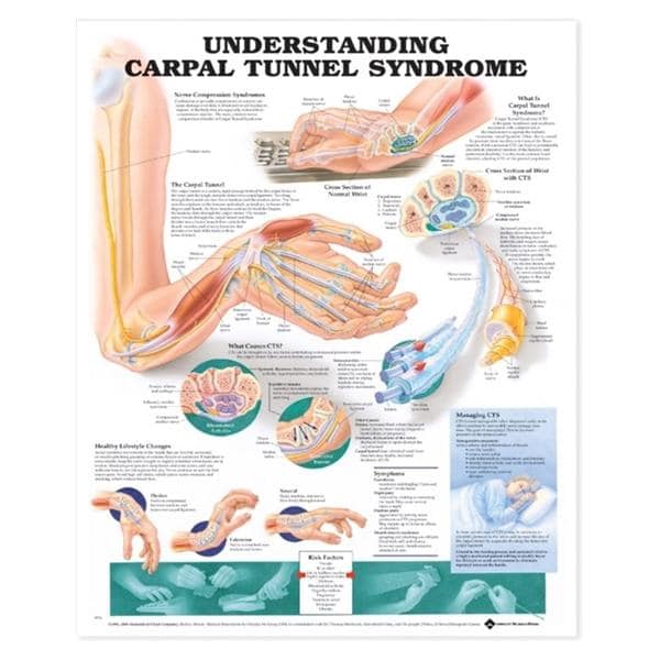 Understanding Carpal Tunnel Syndrome Educational Chart 20x26" Fle...